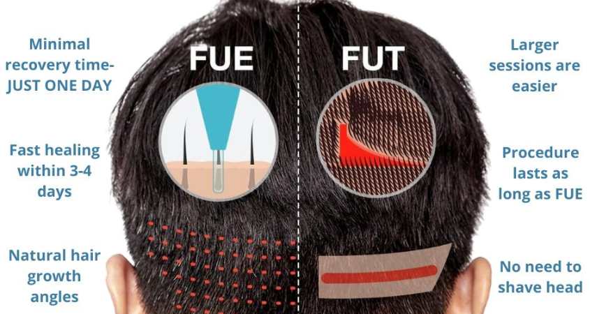 Difference between FUE and FUT