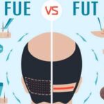 Hair Transplant Surgery: FUE or FUT - Which is the Best Option?