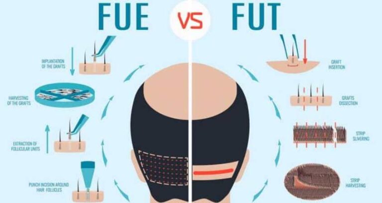 Hair Transplant Surgery: FUE or FUT - Which is the Best Option?